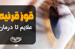 همه چیز درباره قوز قرنیه؛ از تشخیص تا درمان