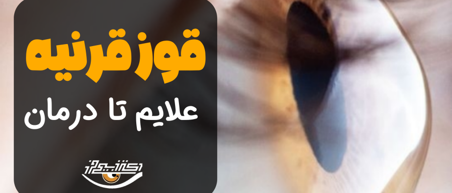 همه چیز درباره قوز قرنیه؛ از تشخیص تا درمان